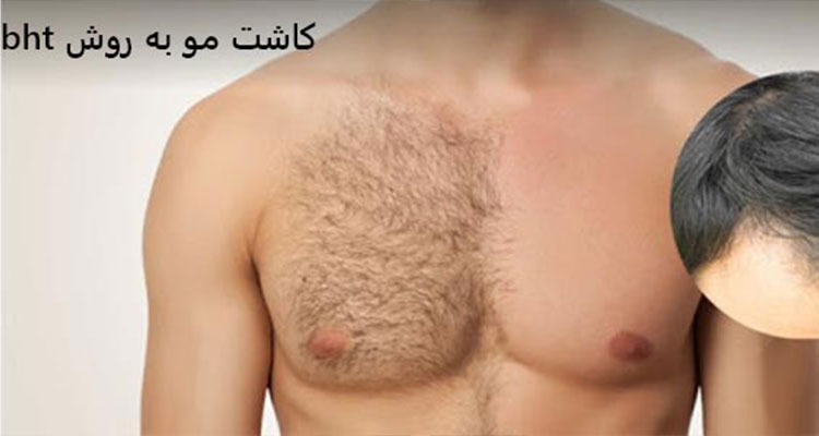 همه چیز در مورد کاشت مو به روش bht | بهترین روش کاشت مو