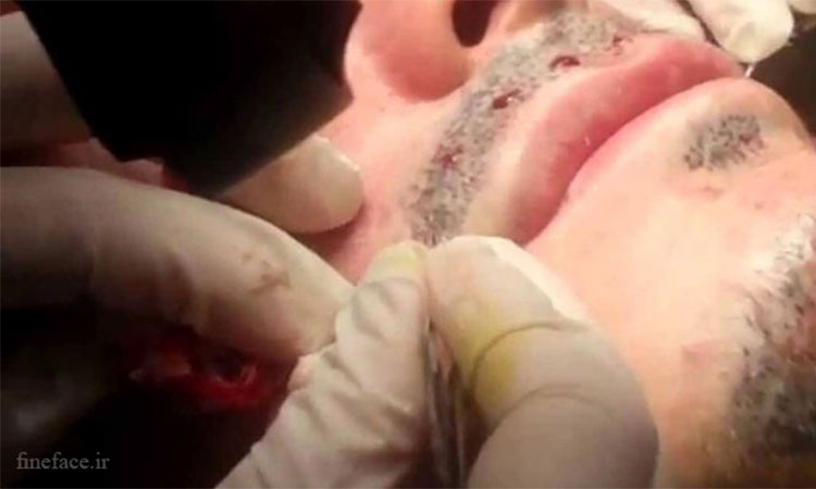 علل ریزش مو ریش و سبیل و روش کاشت